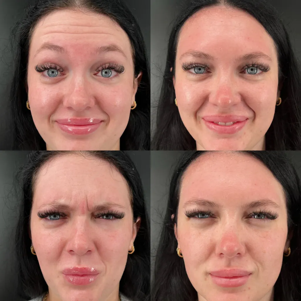 Before and after tox treatment, shown at rest and mid-expression
