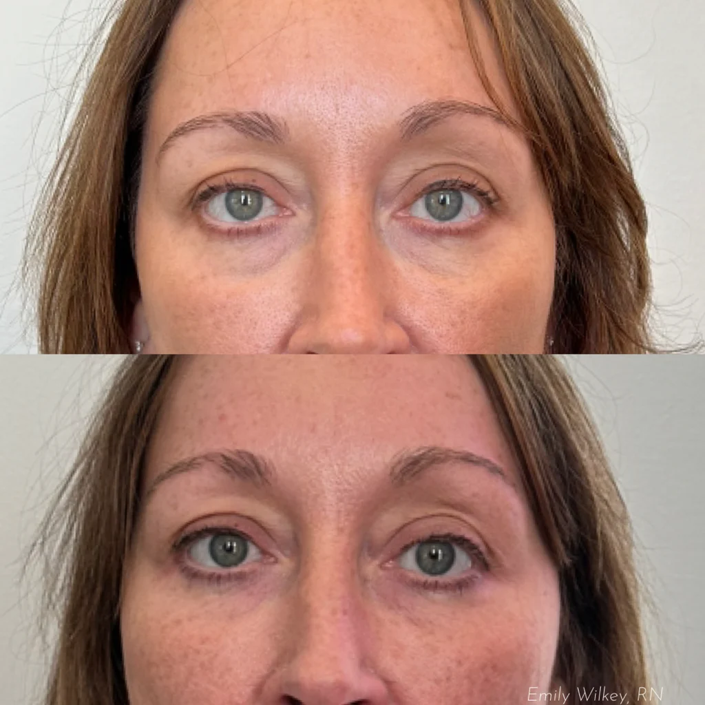 Before and after under-eye and cheek filler, shown front on