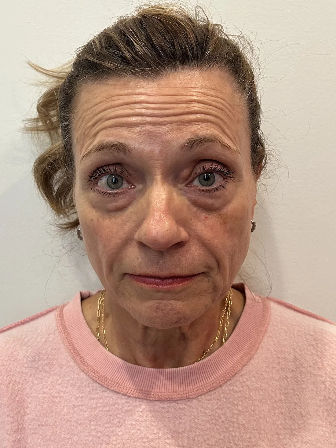 Before treatment