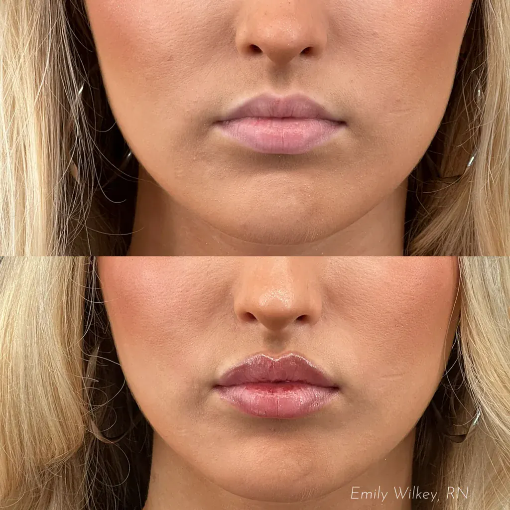 Before and after lip filler, shown front on