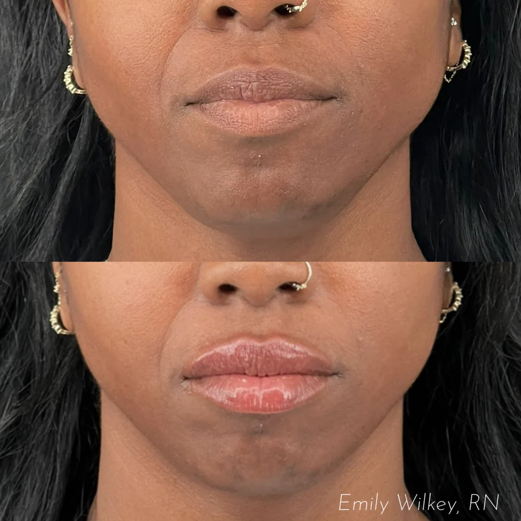 Before and after lip filler with half a syringe
