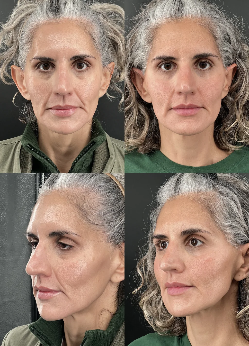 Before and after Sculptra, shown front on and at a three-quarter angle
