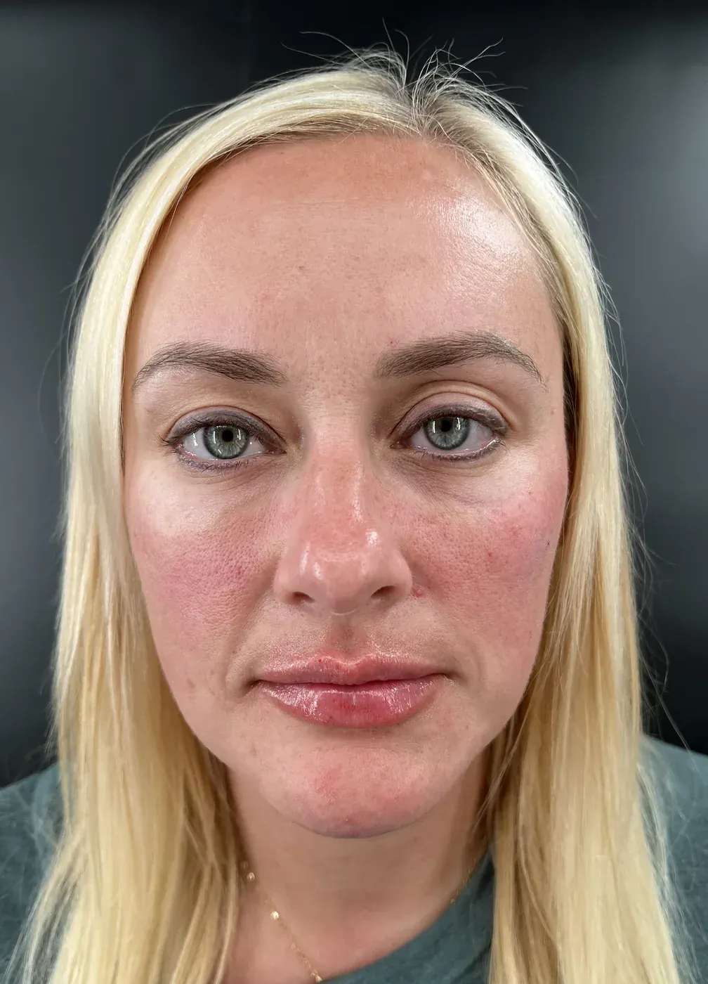 Facial balancing with filler after treatment