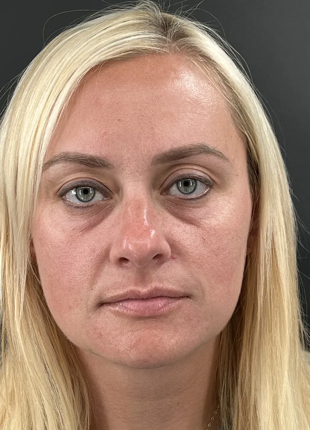 Facial balancing with filler before treatment