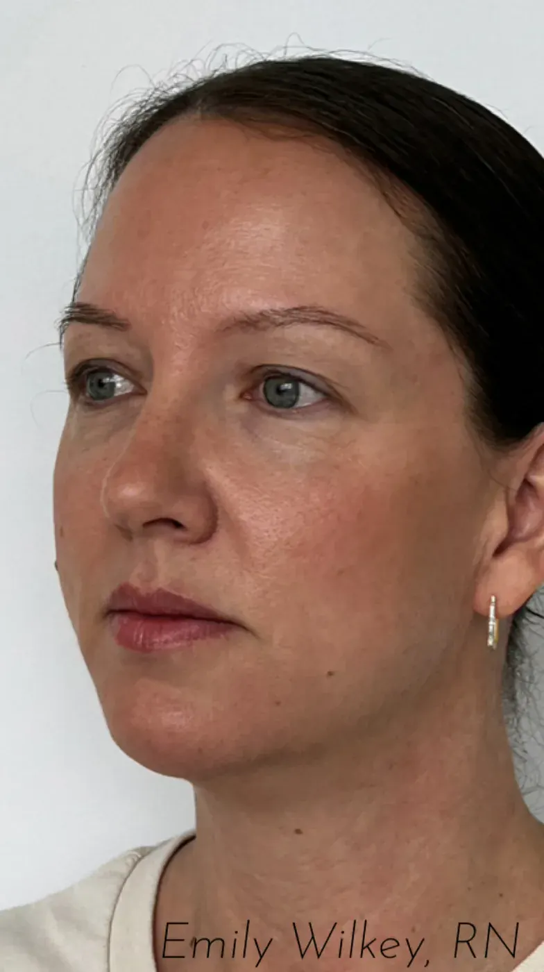 Biostimulators after treatment