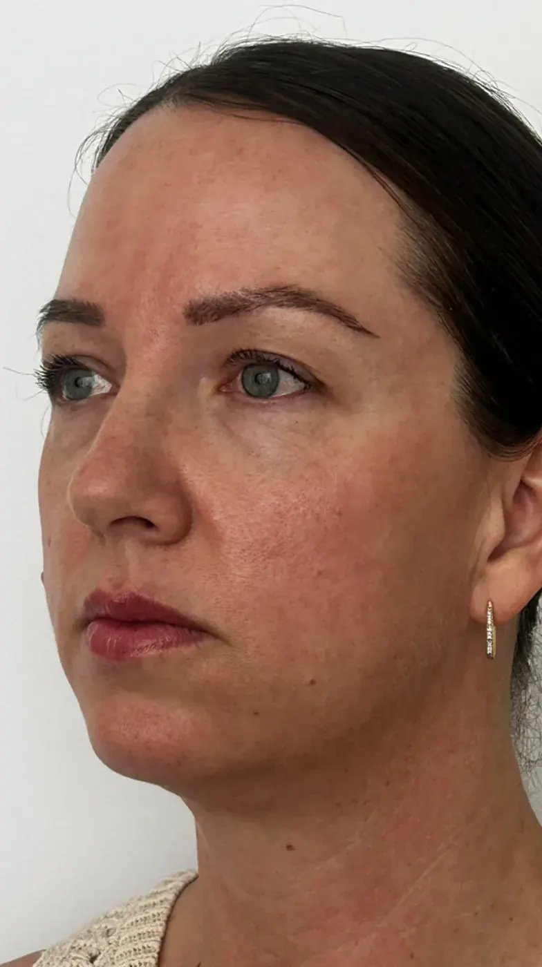 Biostimulators before treatment