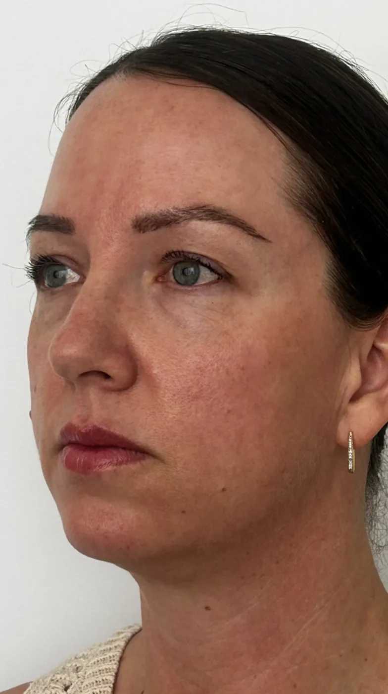 Dermal filler before treatment