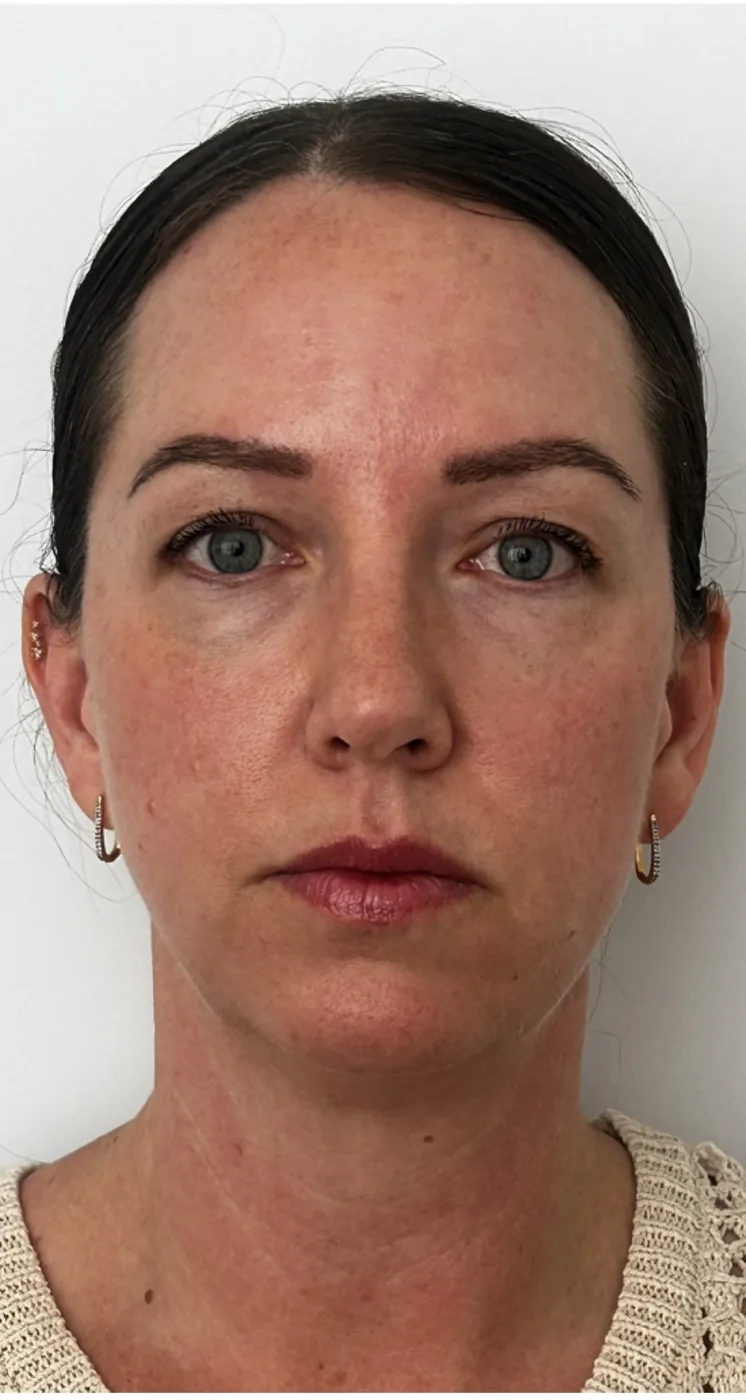 Dermal filler after treatment