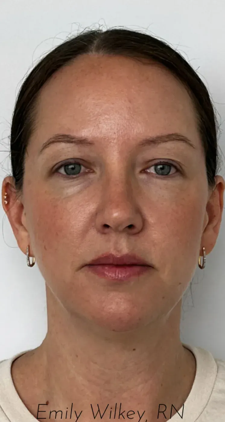 Biostimulators before treatment