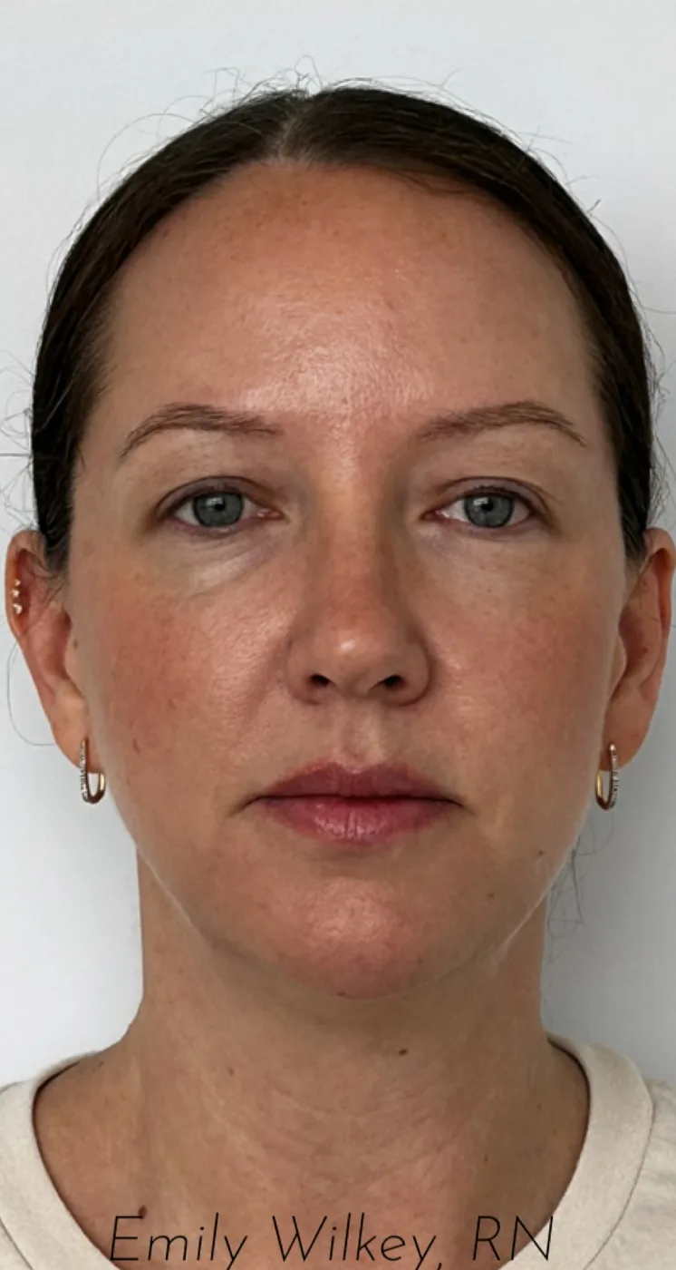Dermal filler before treatment