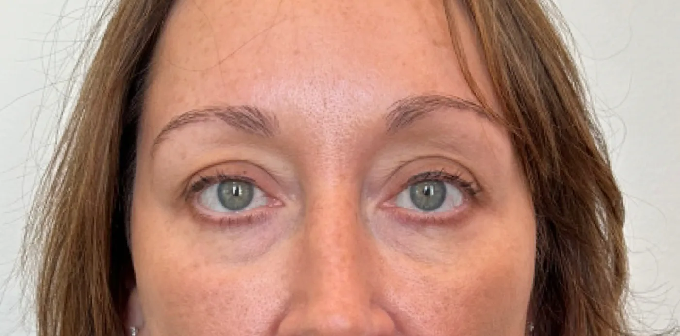 Dermal filler after treatment