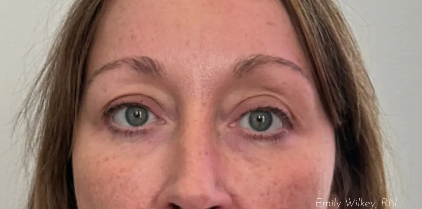 Dermal filler before treatment