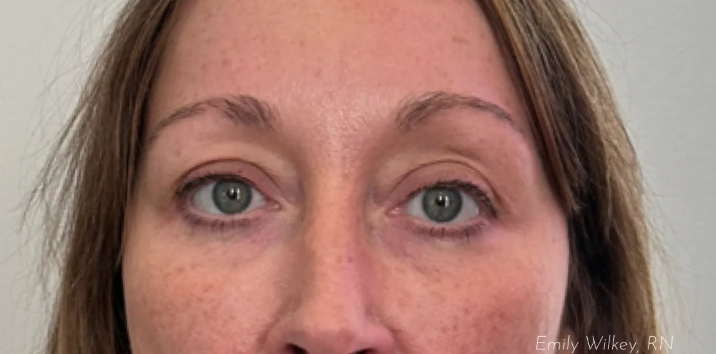 Dermal filler before treatment