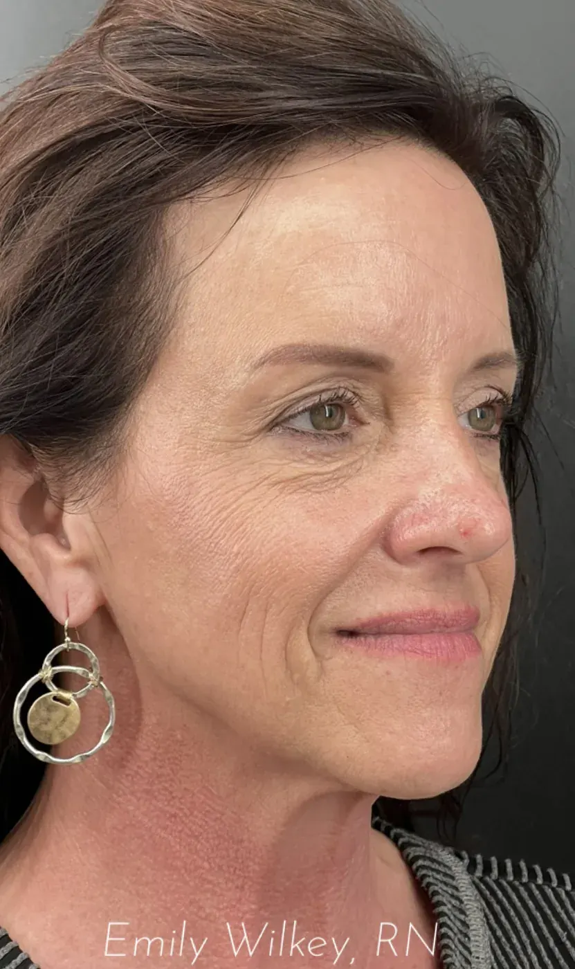 IPL photofacial after treatment