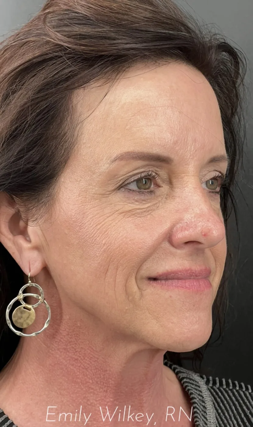 IPL photofacial after treatment