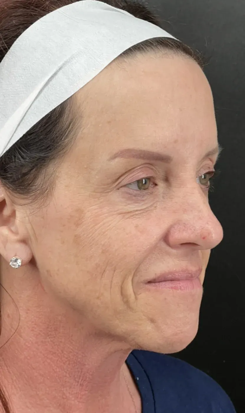 IPL photofacial before treatment