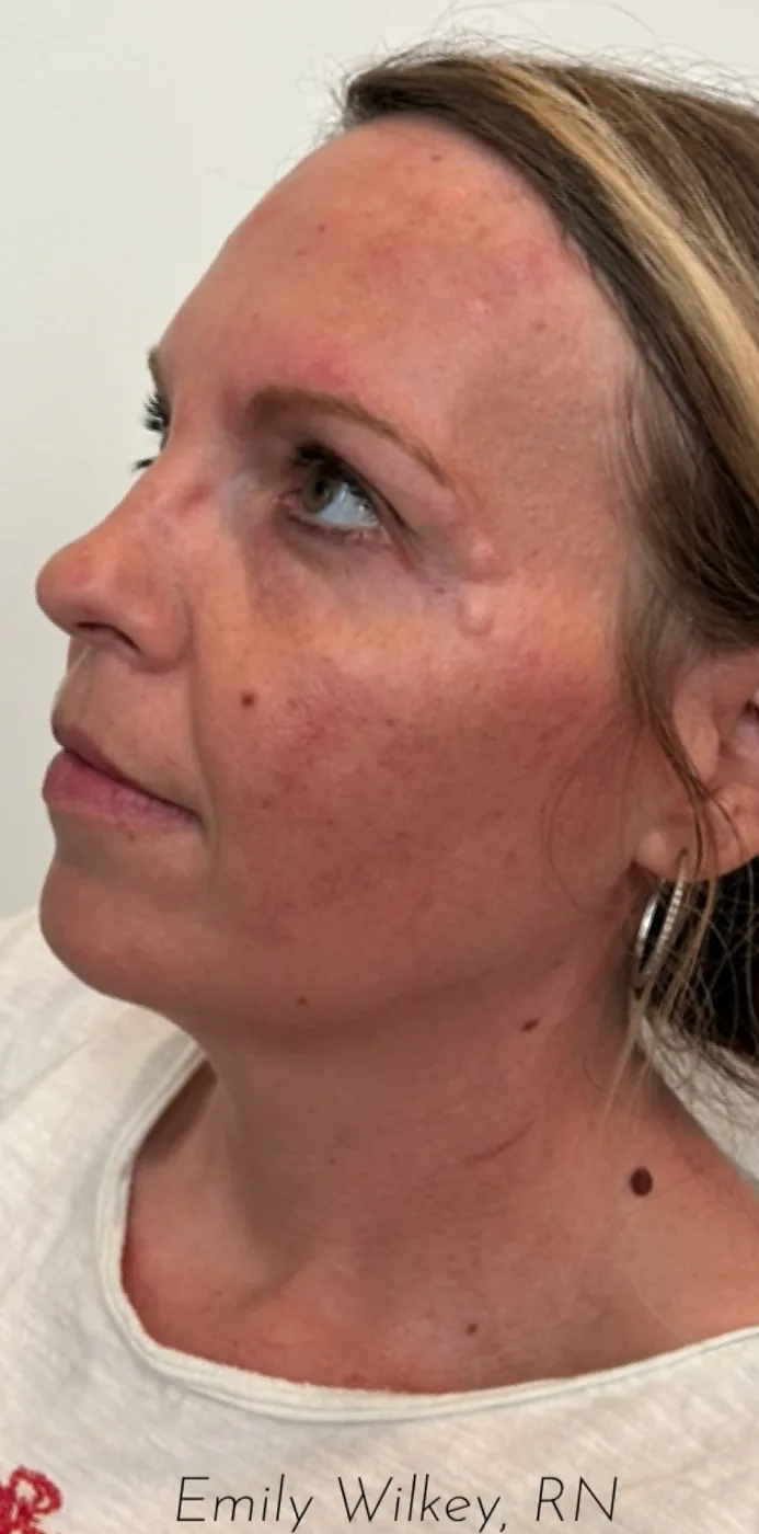 IPL photofacial after treatment