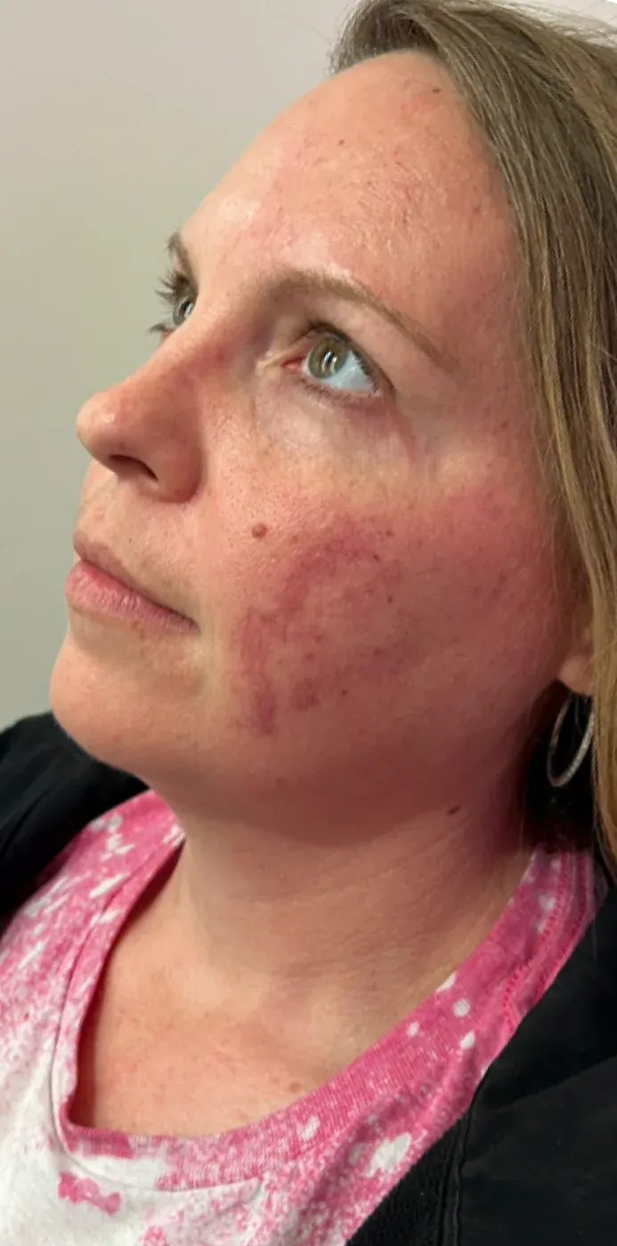 IPL photofacial before treatment