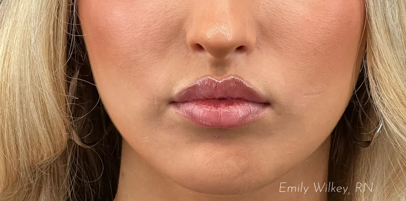 Lip filler after treatment