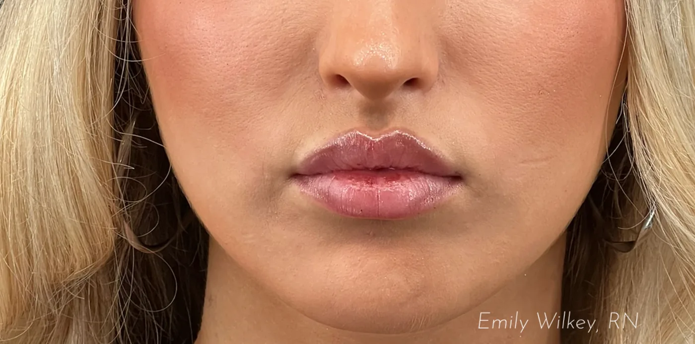 Lip filler after treatment