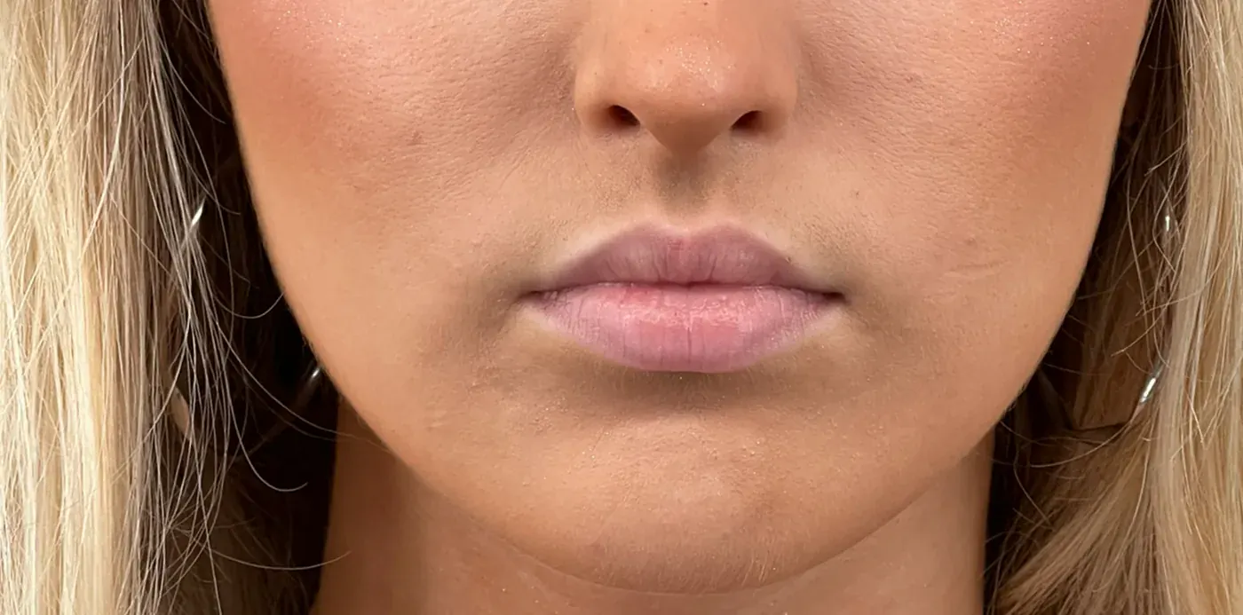 Lip filler before treatment