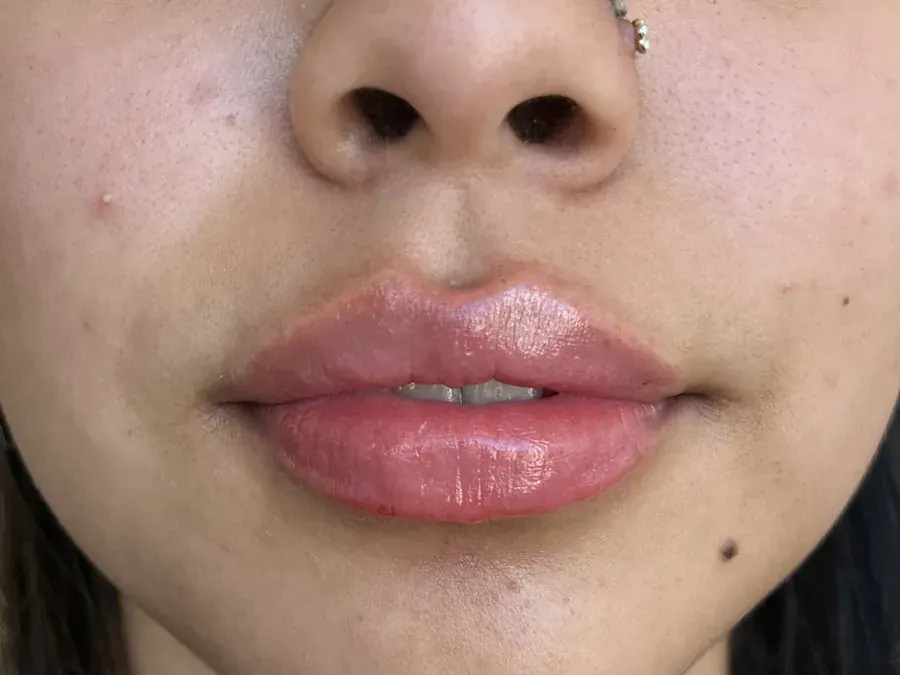 Lip filler after treatment