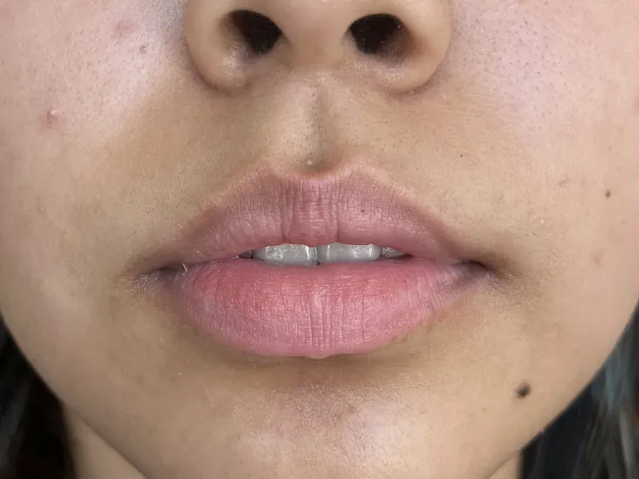 Lip filler before treatment