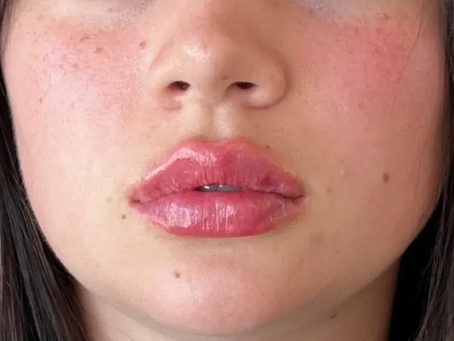 Lip filler after treatment