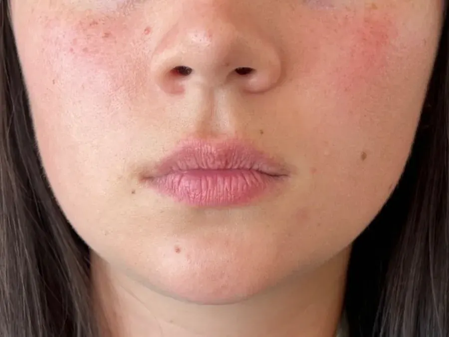 Lip filler before treatment