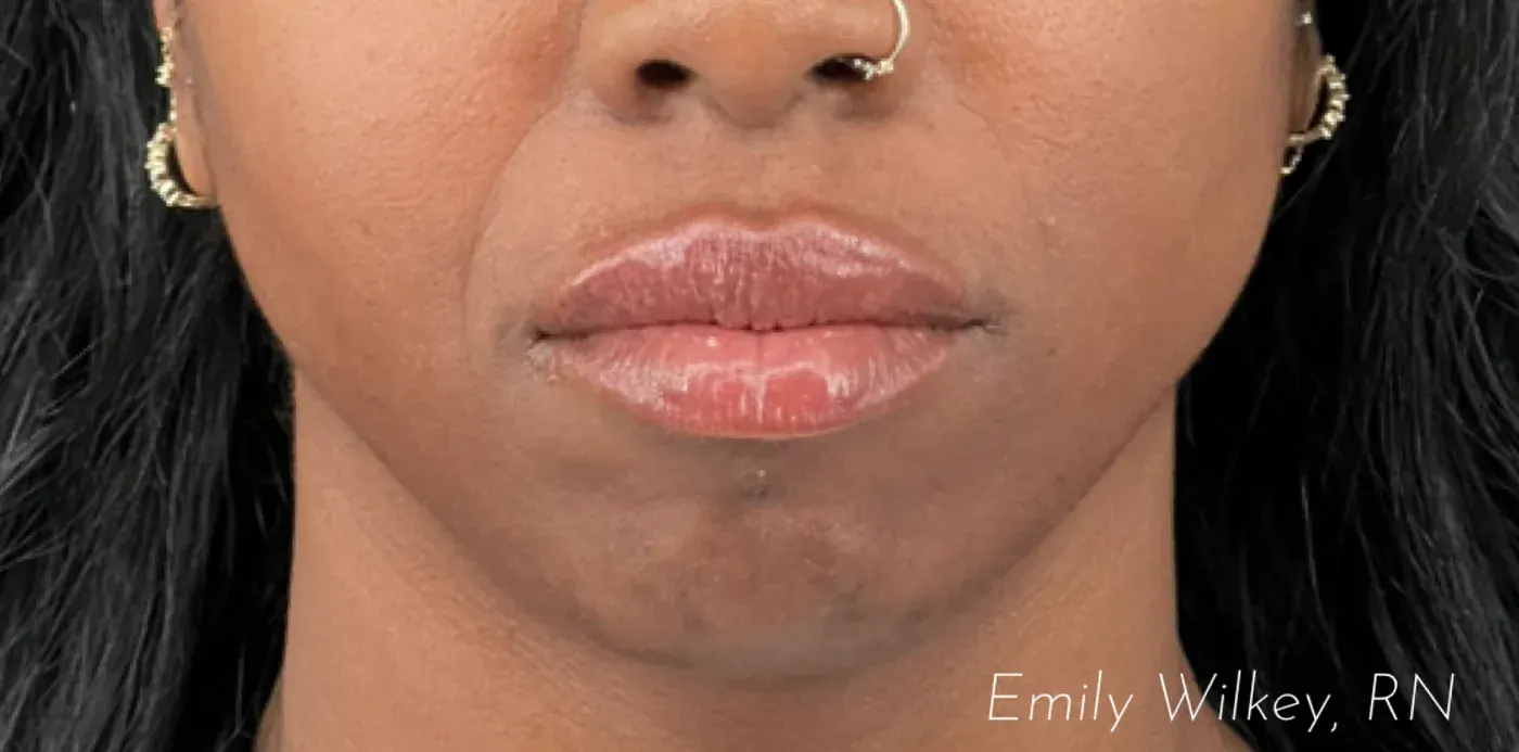 Lip filler after treatment
