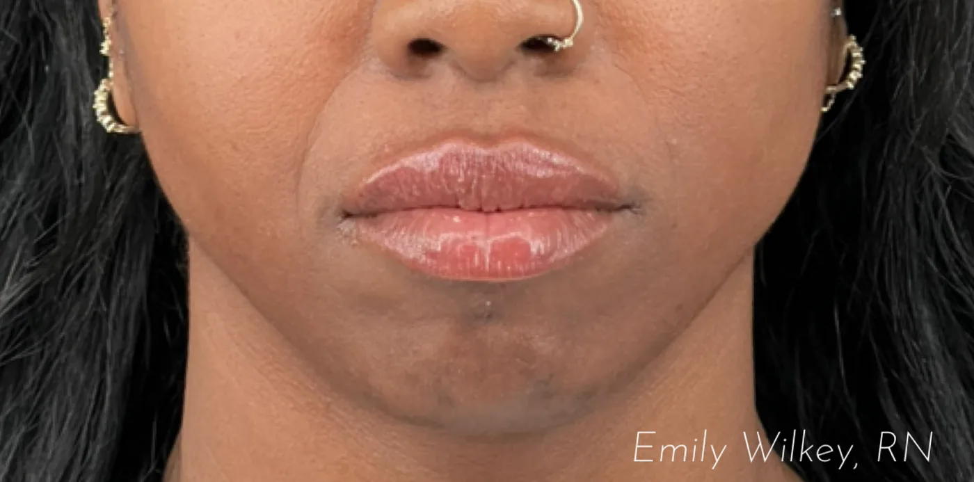 Lip filler after treatment