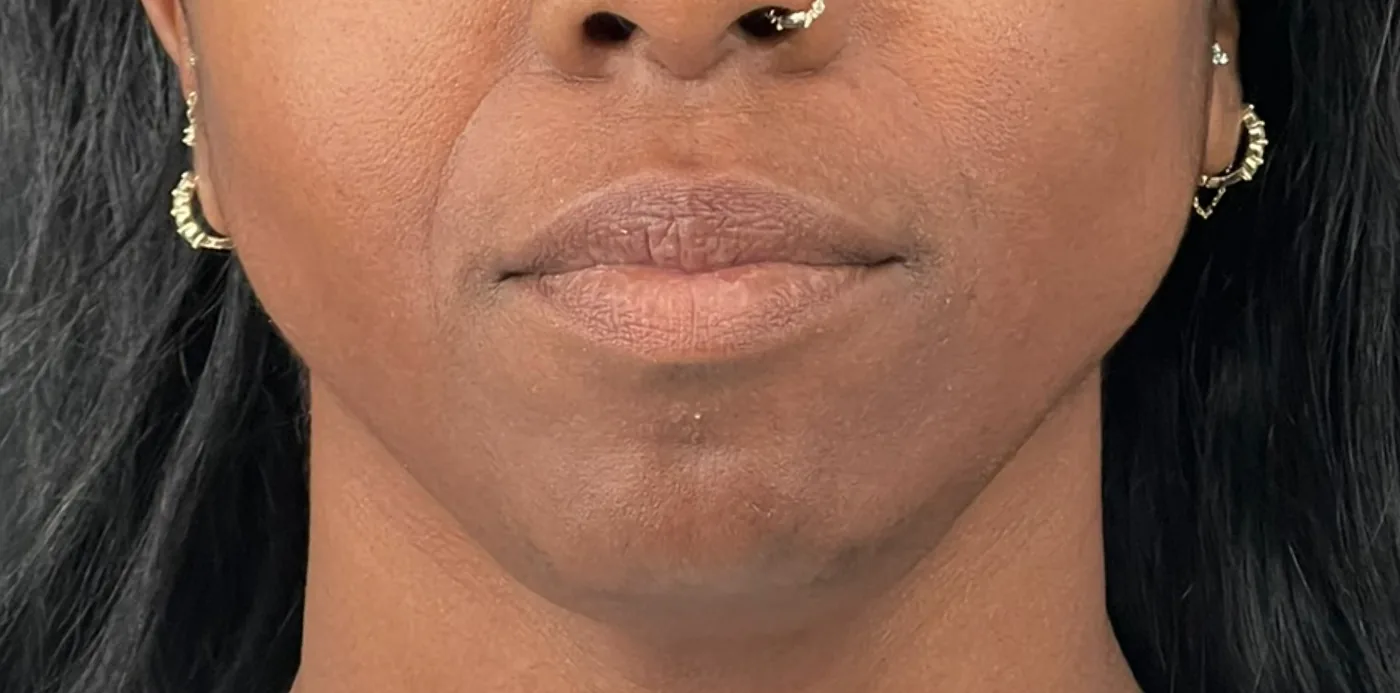 Lip filler before treatment