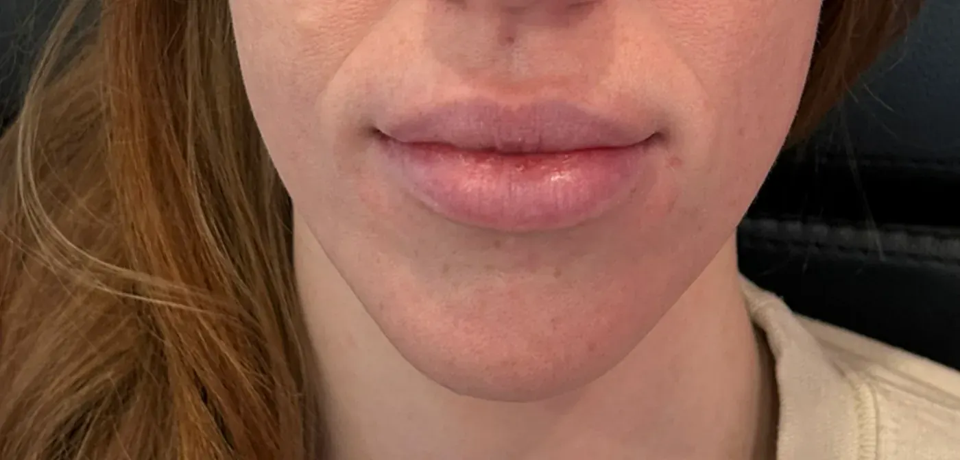 Lip filler after treatment
