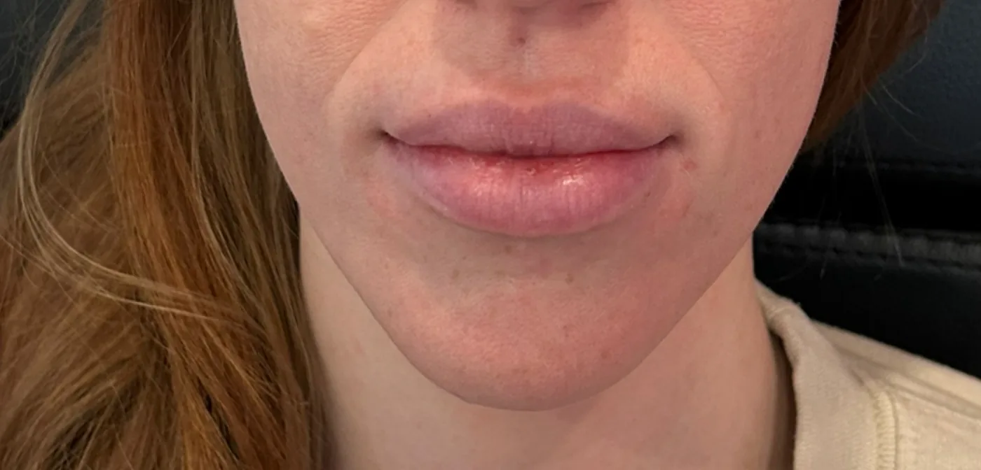 Lip filler after treatment