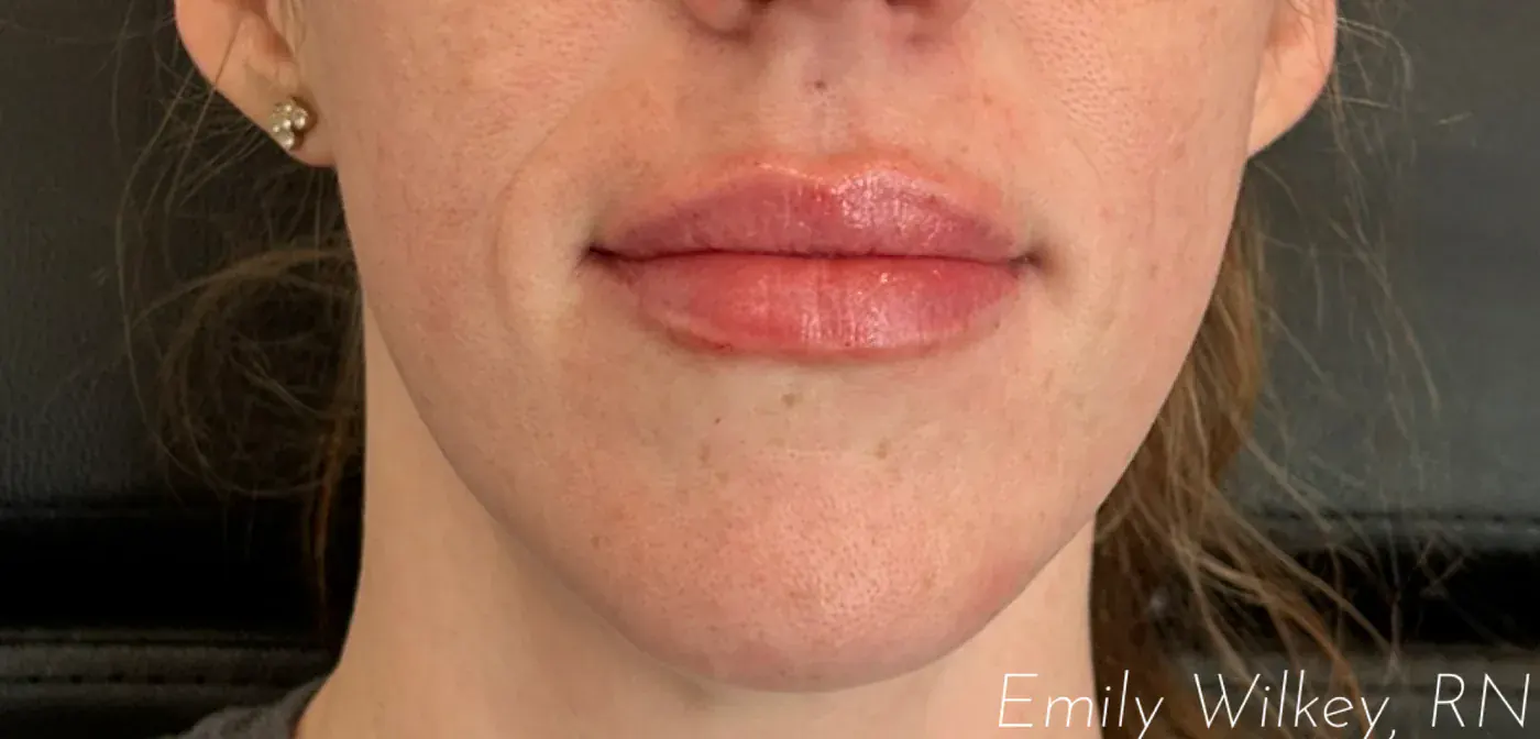 Lip filler before treatment