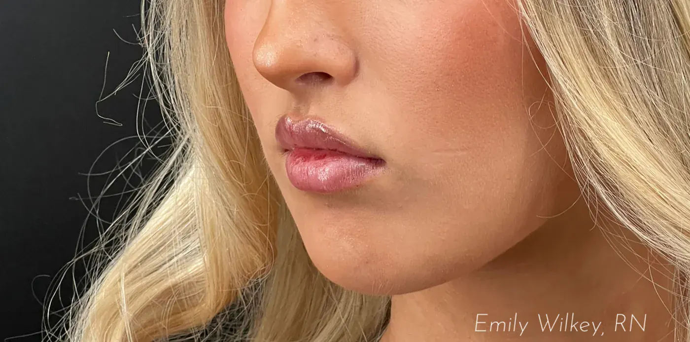 Lip filler after treatment