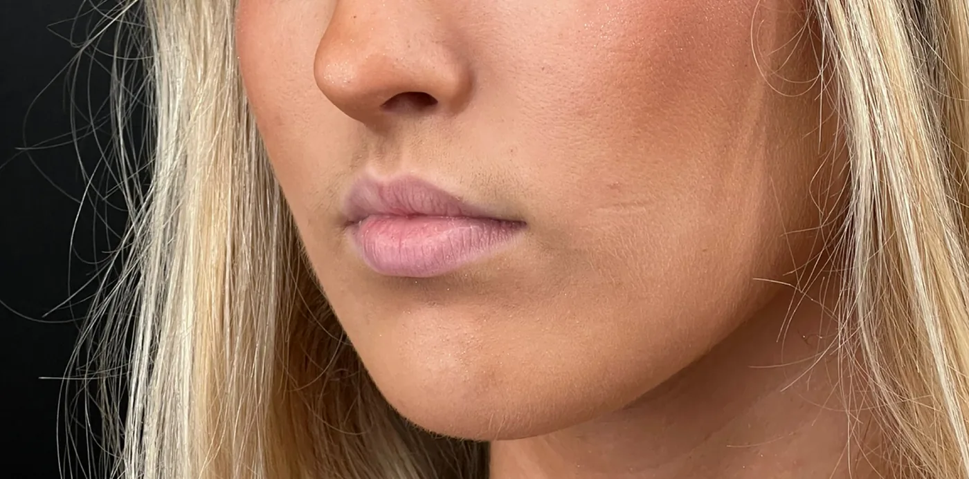 Lip filler before treatment