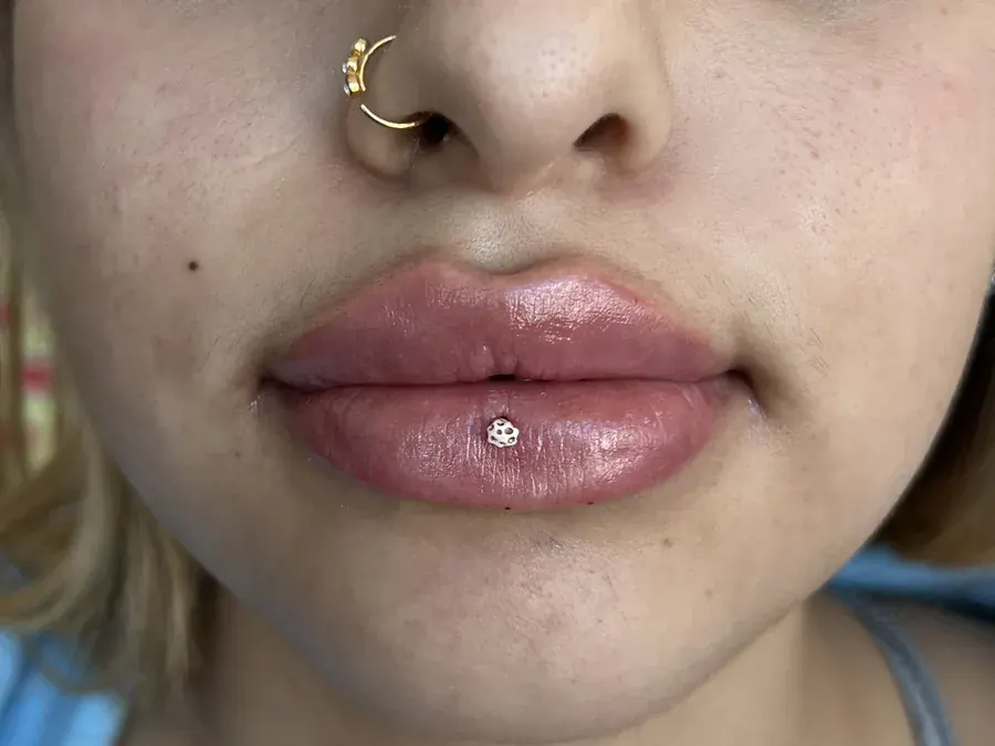 Lip filler after treatment