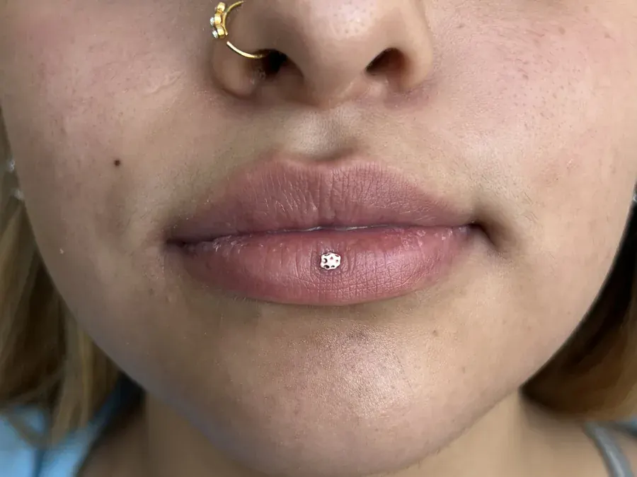 Lip filler before treatment