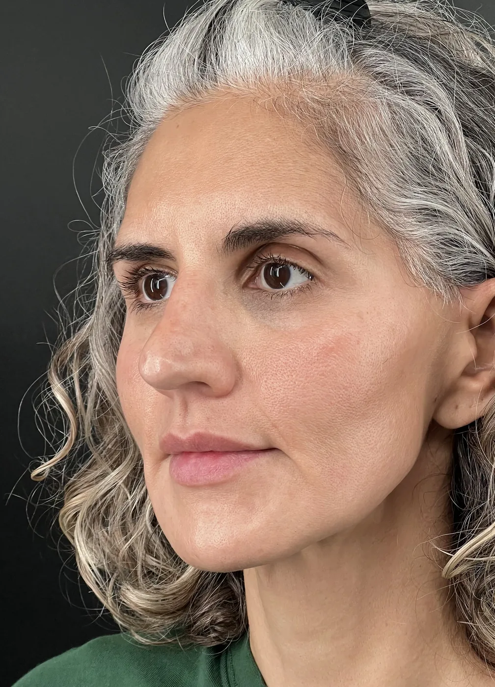 Biostimulators after treatment