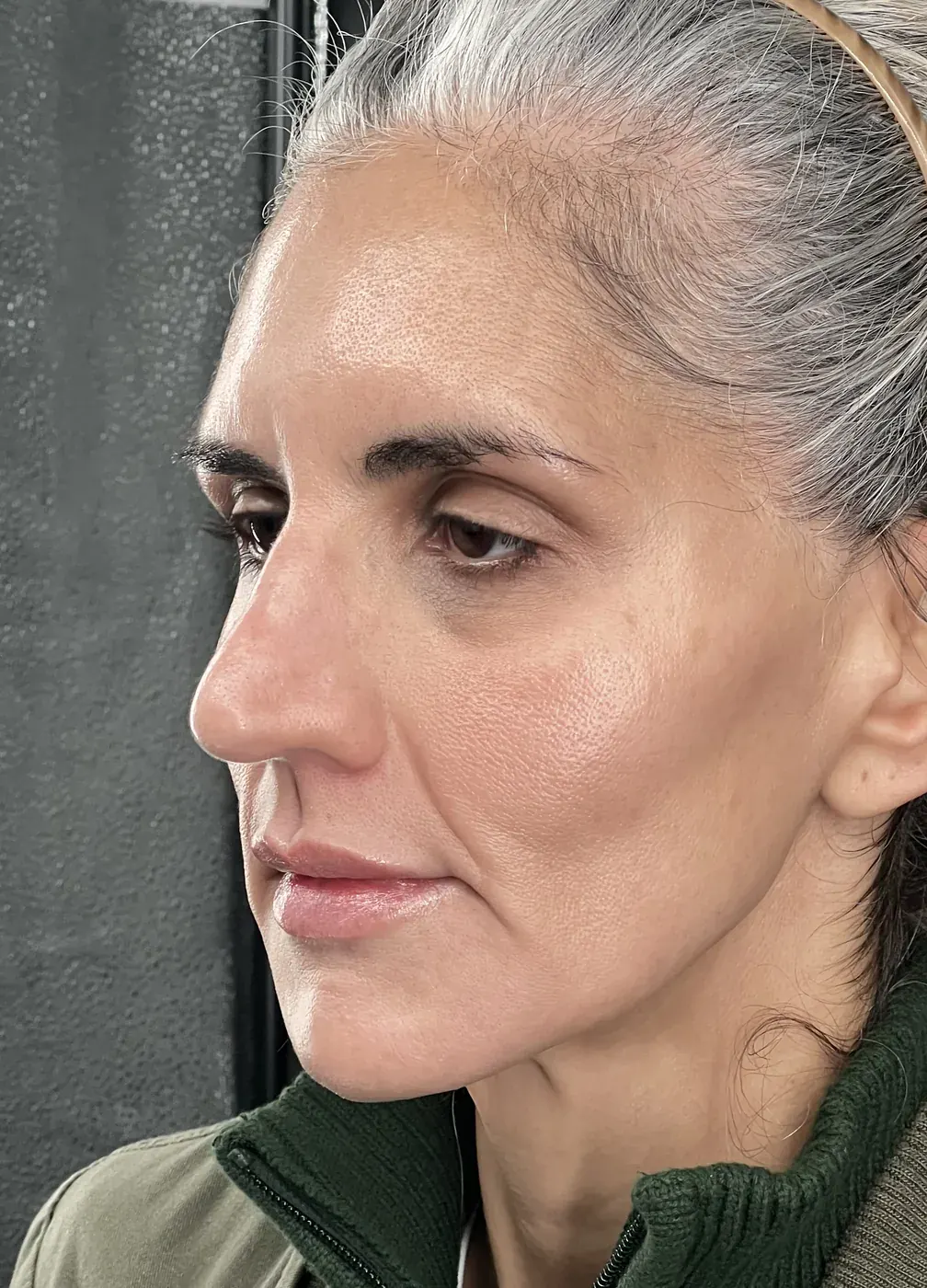Biostimulators before treatment