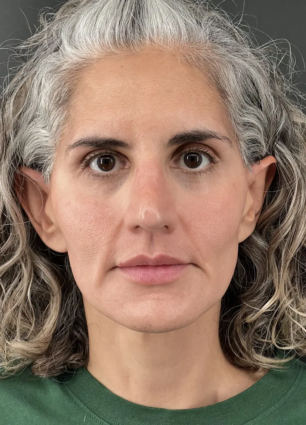 Biostimulators after treatment