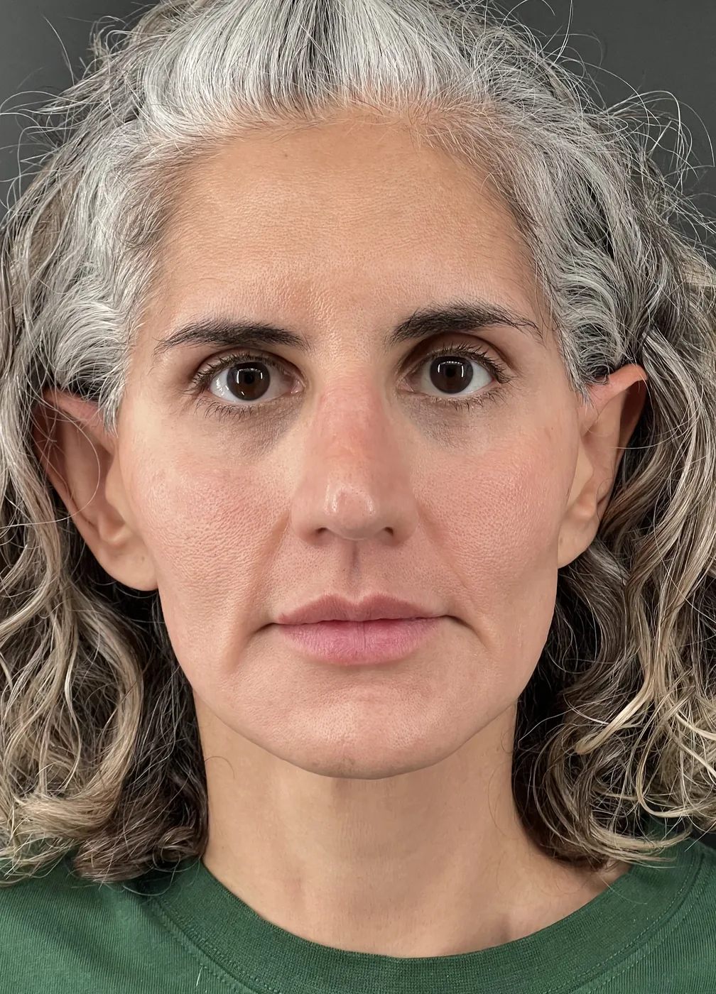 Biostimulators after treatment