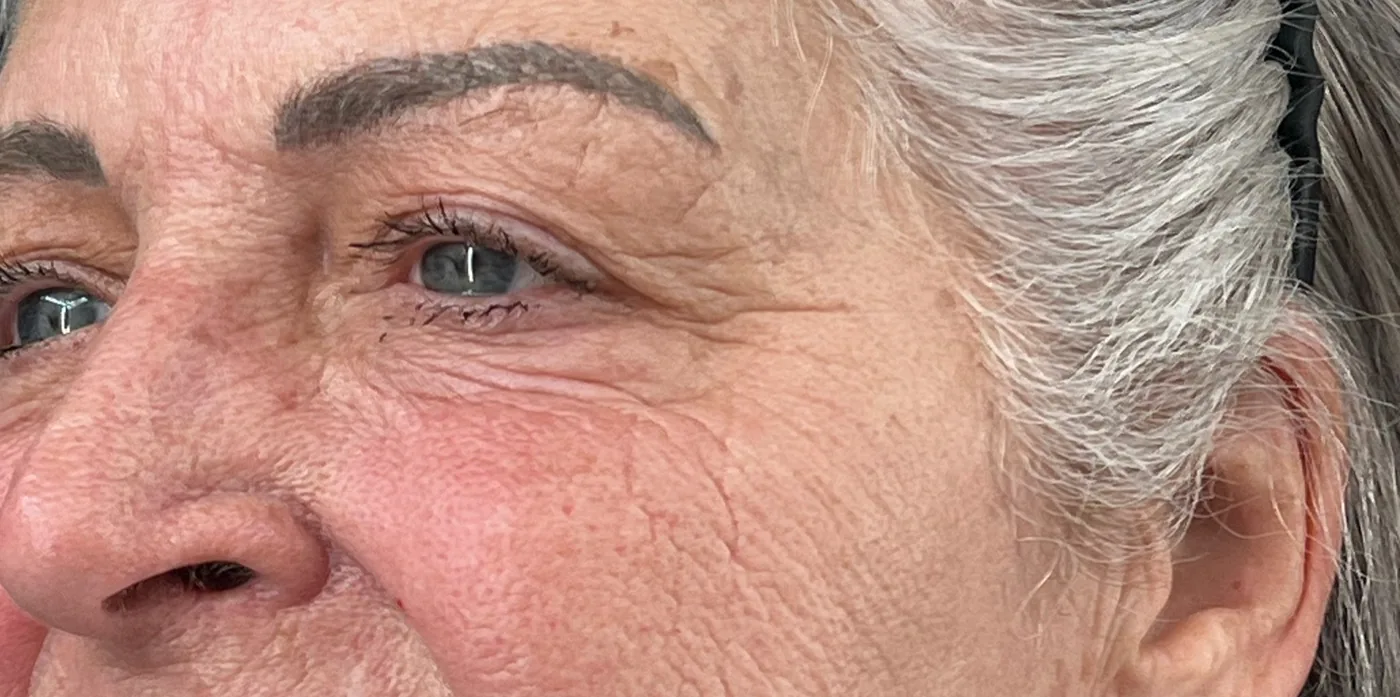 Tixel after treatment