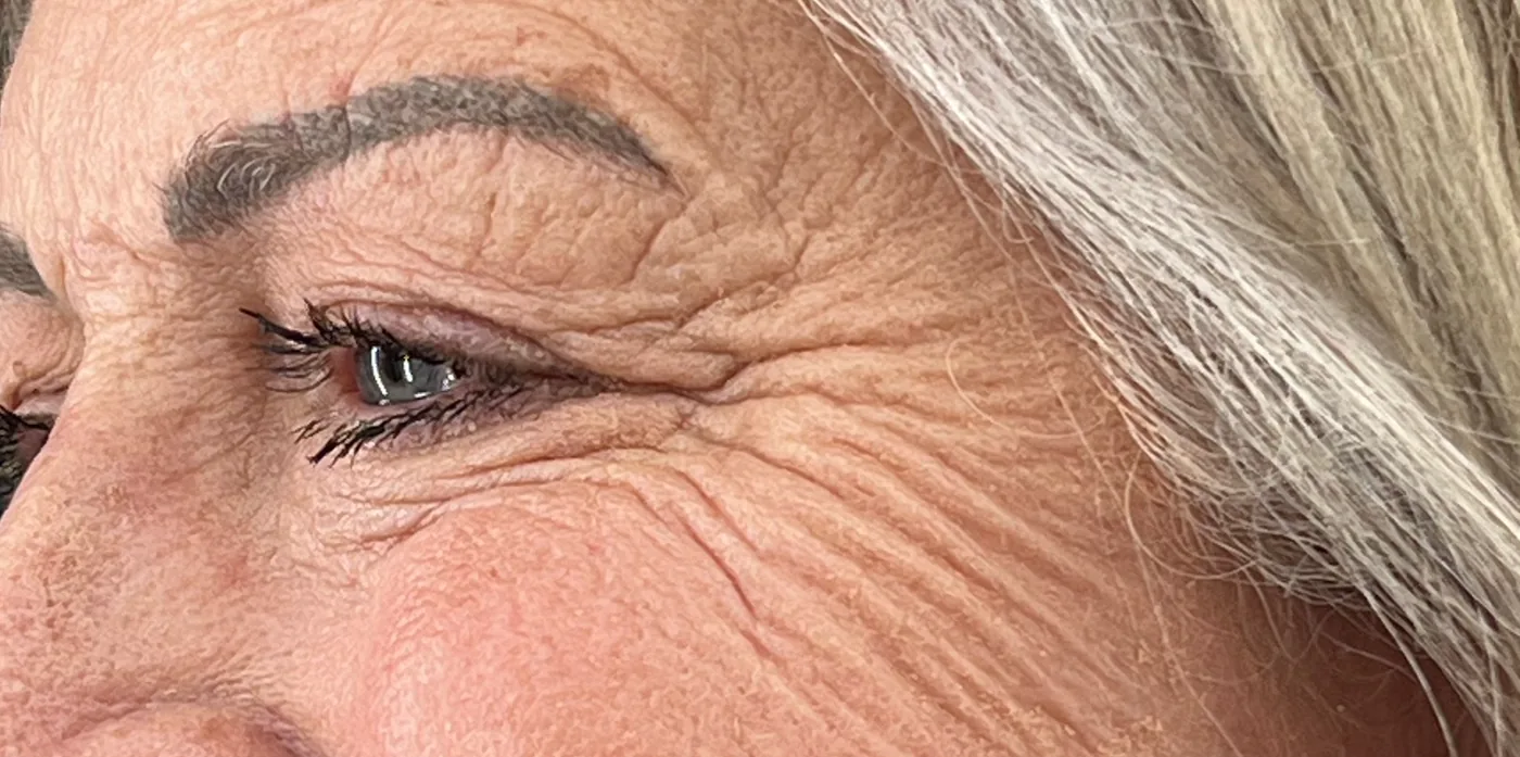 Tixel before treatment