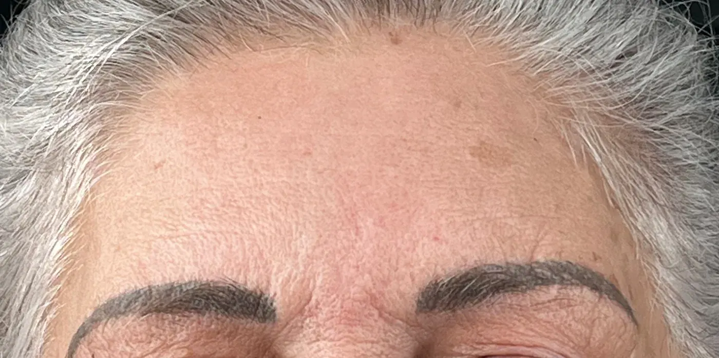 Tixel after treatment