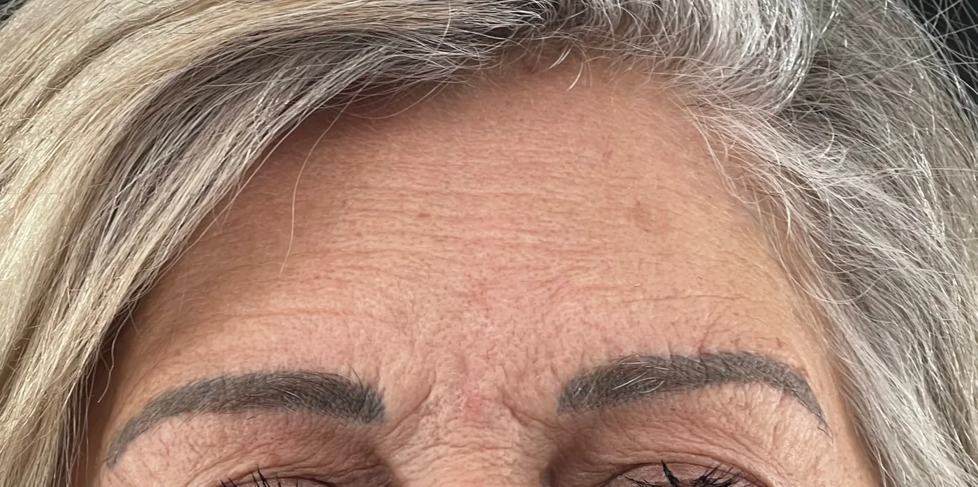 Tixel before treatment