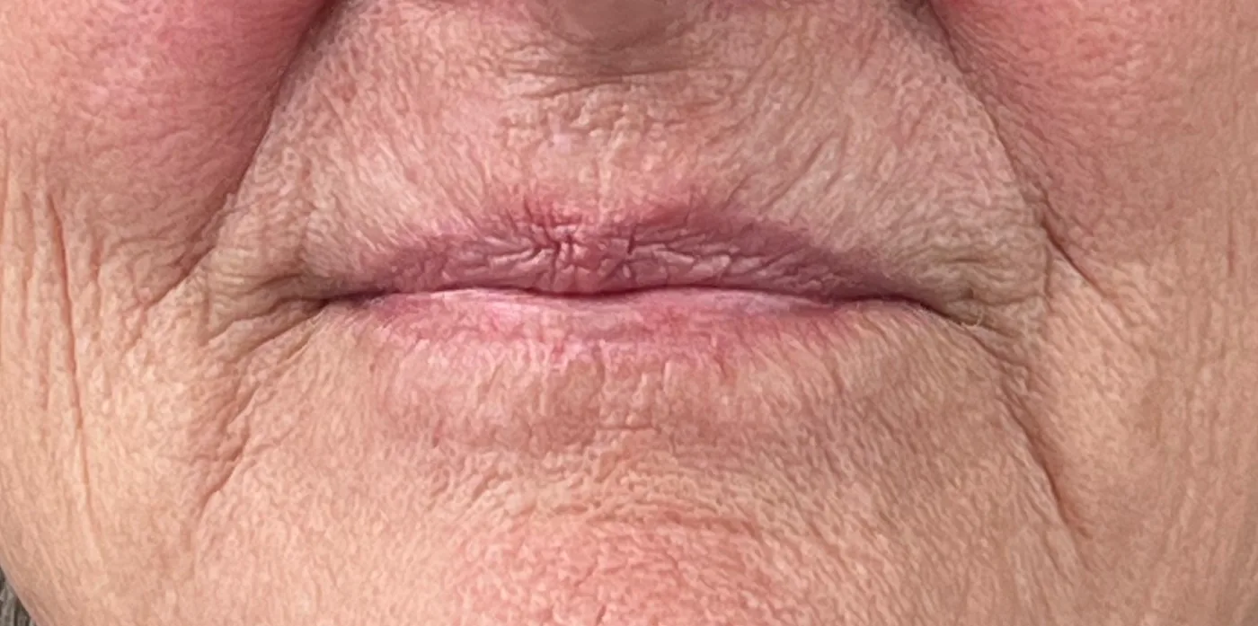 Tixel after treatment