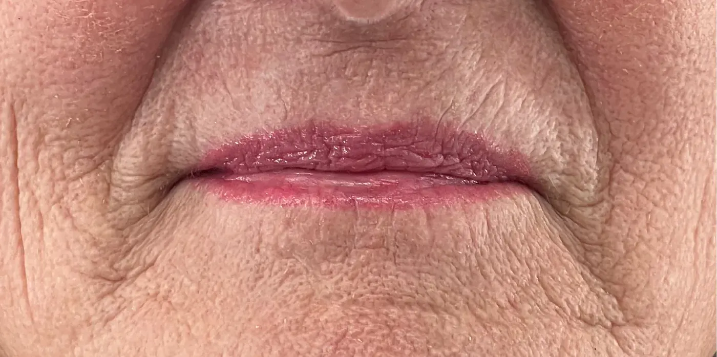 Tixel before treatment