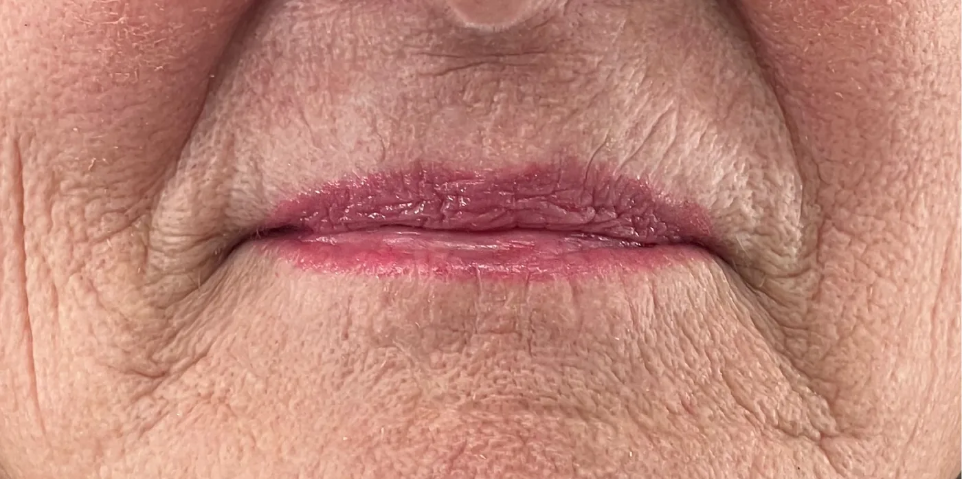 Tixel before treatment